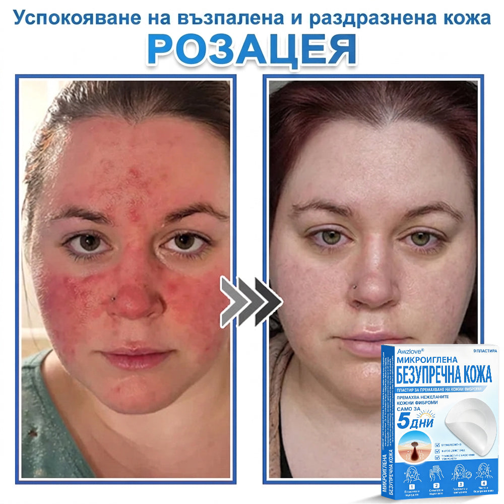 Awzlove® 2-в-1 пластир с микроигли и хидроколоид | Премахва повдигнати бенки, акне, плоски брадавици и кожни образувания | Подобрява бръчки, белези и несъвършенства | Невидими звездовидни пластири за лице и тяло |🐒🐶1