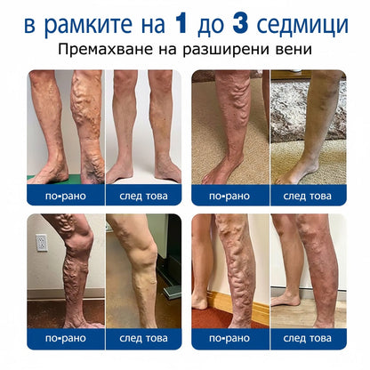 🧙‍♂️🎷  H𝐞a𝐥r𝐢z𝐞® VeinEase Микроиглен Пластир ⚡ Мигновено Облекчение, Дълготрайни Резултати🏃‍♂️‍➡️🏃‍♂️‍➡️3