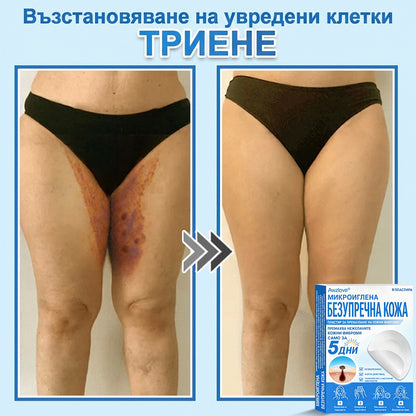 Awzlove® 2-в-1 пластир с микроигли и хидроколоид | Премахва повдигнати бенки, акне, плоски брадавици и кожни образувания | Подобрява бръчки, белези и несъвършенства | Невидими звездовидни пластири за лице и тяло |🐒🐶1