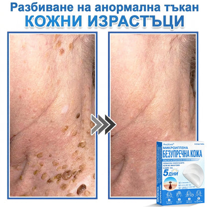 Awzlove® 2-в-1 пластир с микроигли и хидроколоид | Премахва повдигнати бенки, акне, плоски брадавици и кожни образувания | Подобрява бръчки, белези и несъвършенства | Невидими звездовидни пластири за лице и тяло |🐒🐶1