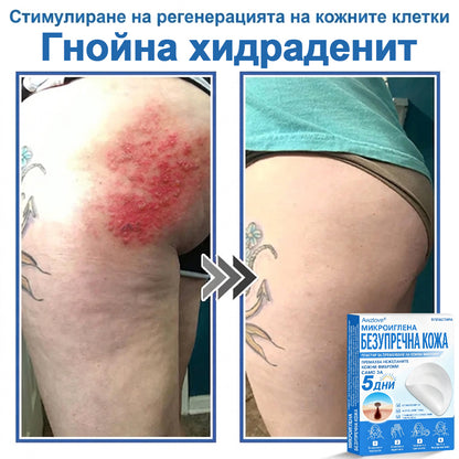 Awzlove® 2-в-1 пластир с микроигли и хидроколоид | Премахва повдигнати бенки, акне, плоски брадавици и кожни образувания | Подобрява бръчки, белези и несъвършенства | Невидими звездовидни пластири за лице и тяло |🐒🐶1